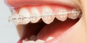 brackets-clinic-dental-servans-ciudad-lineal-zafiro-5