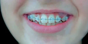 brackets-clinic-dental-servans-ciudad-lineal-zafiro-7
